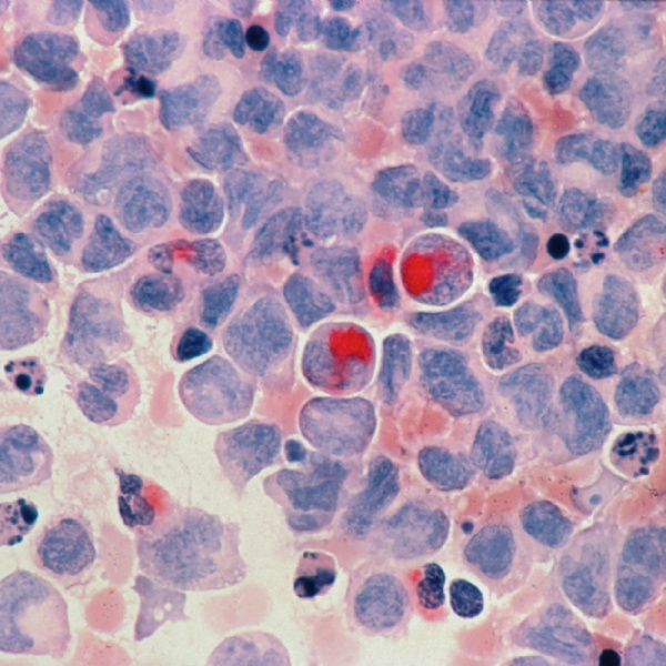 Intravenös C-vitamin vid cancer: Effekt på trötthet och livskvalitet